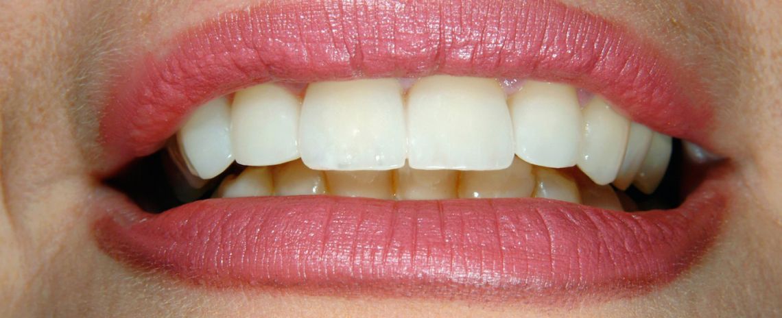 Veneers After