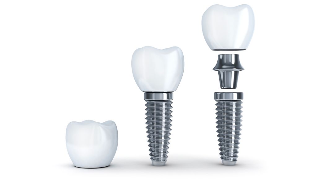 Dental Implants Components