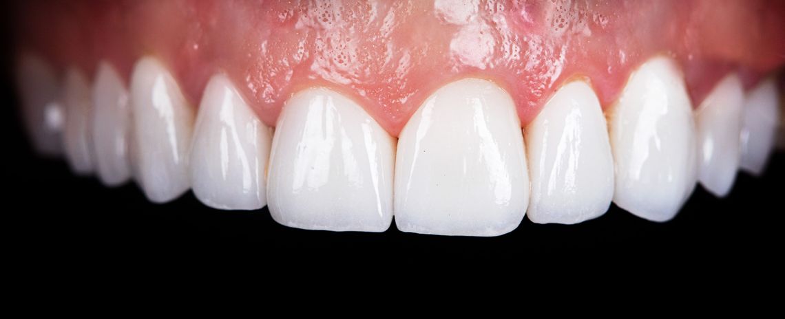 Whitening and Crowns After