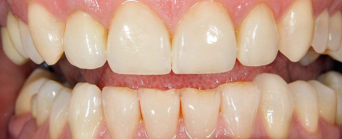 Composite Bonding and Whitening After
