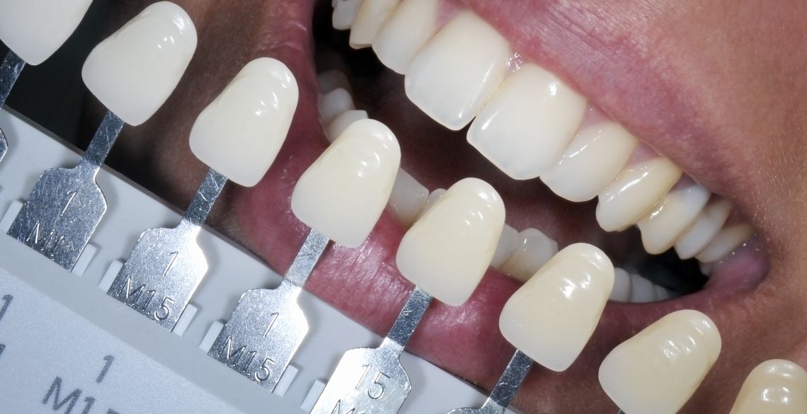 Teeth Whitening