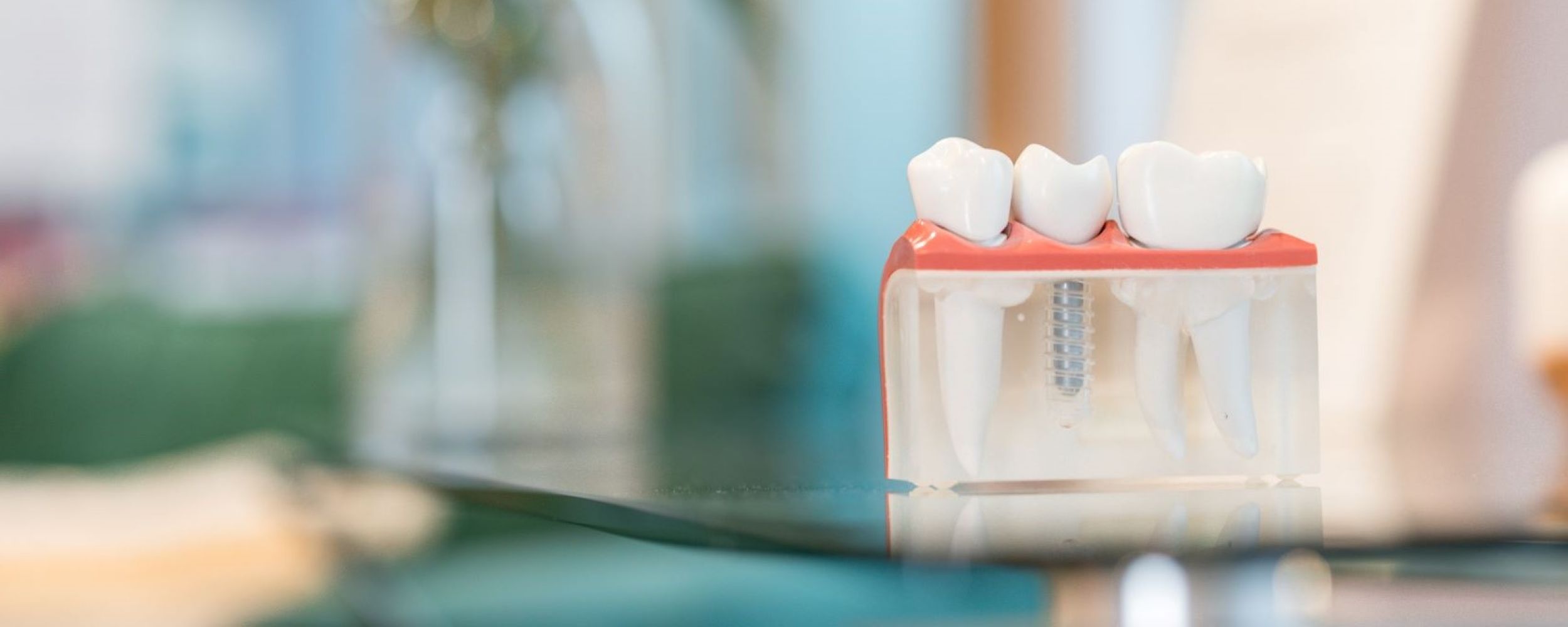 Dental implant journey