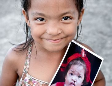 operation smile