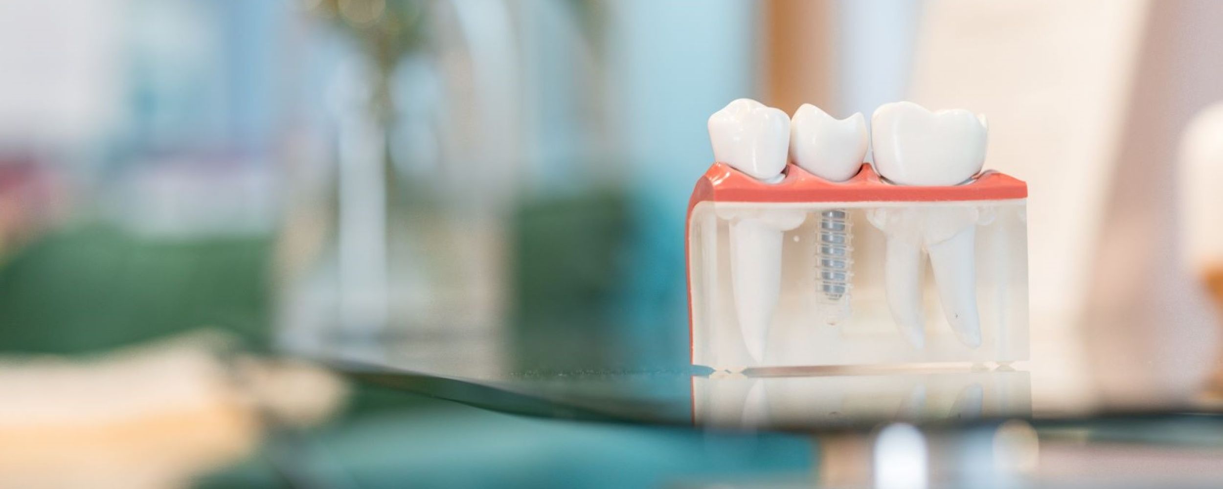 Single tooth dental implants