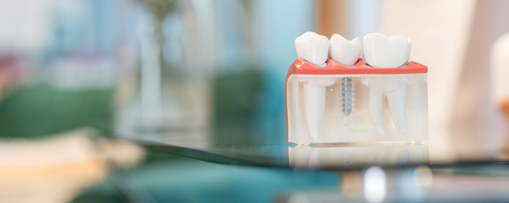 Dental Implants. Are They Worth It?