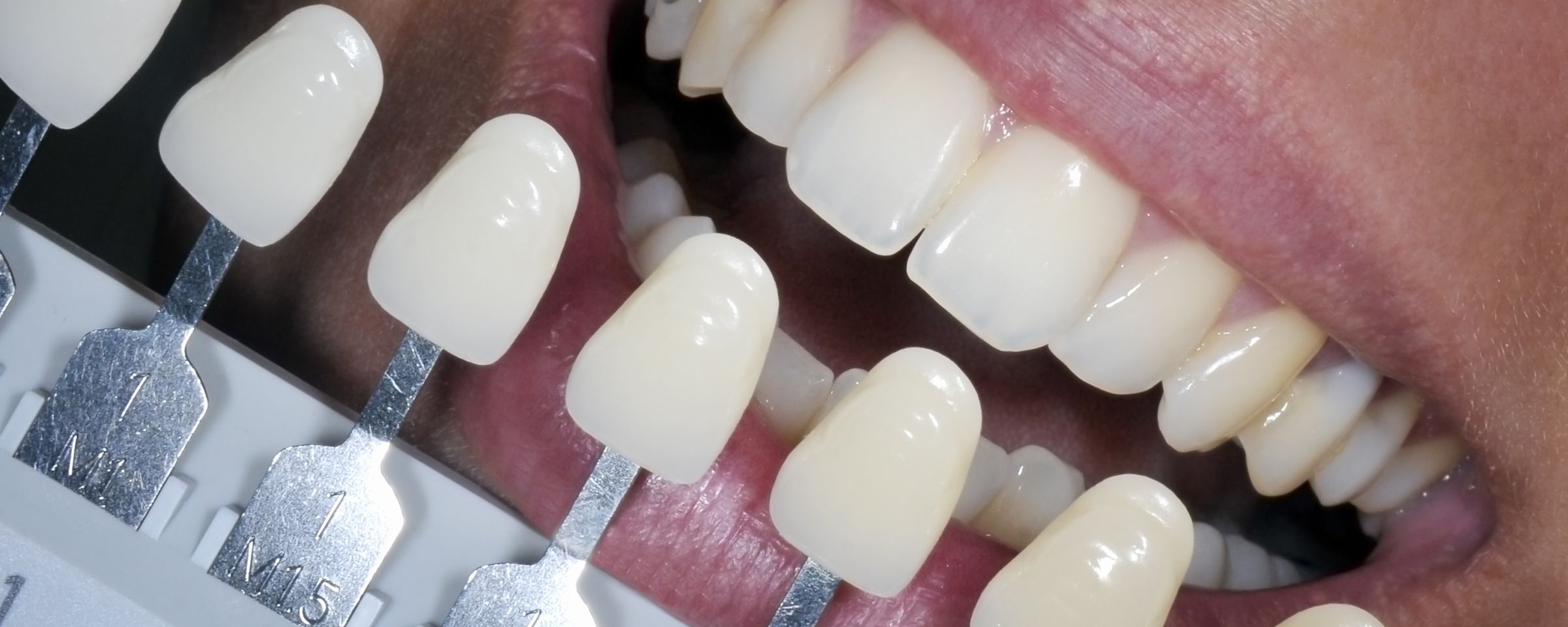 Teeth Whitening