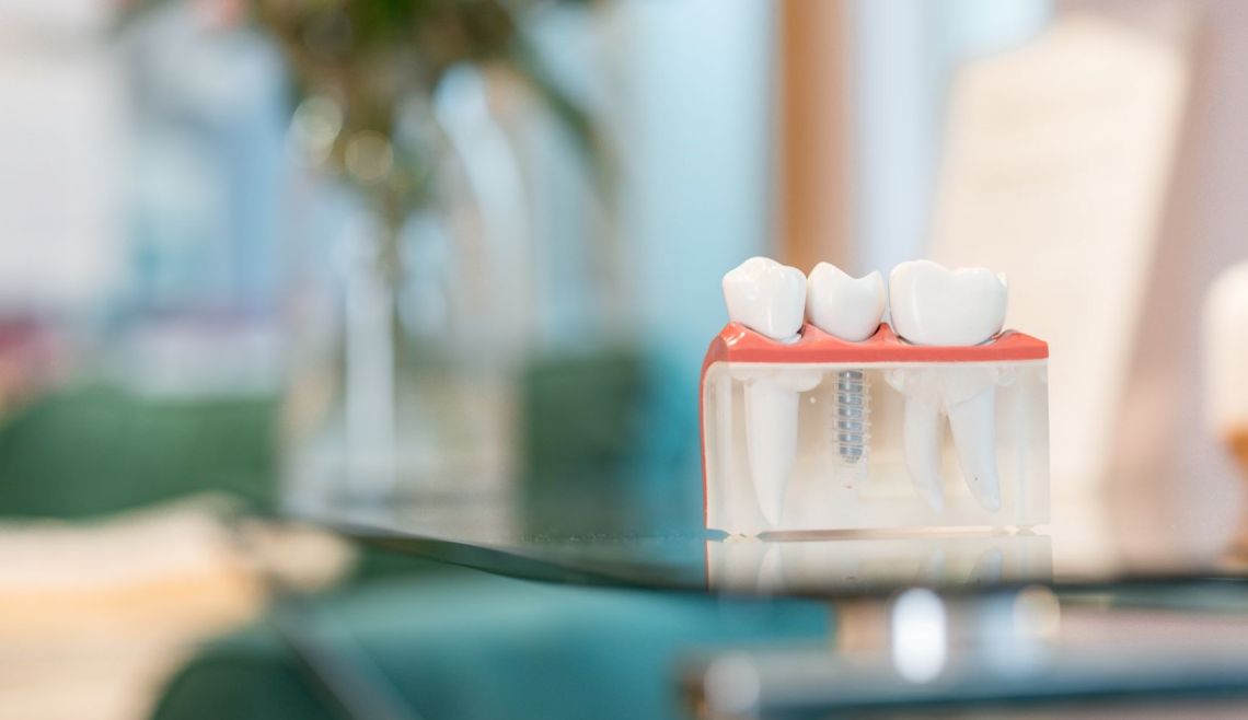 Dental Implants. Are They Worth It?