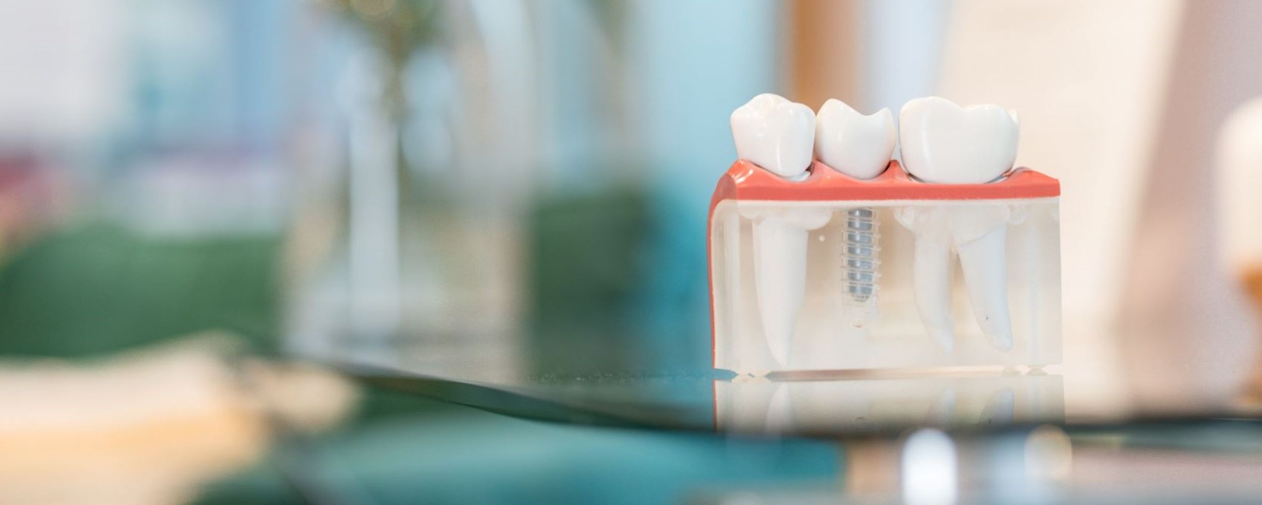 Dental implants