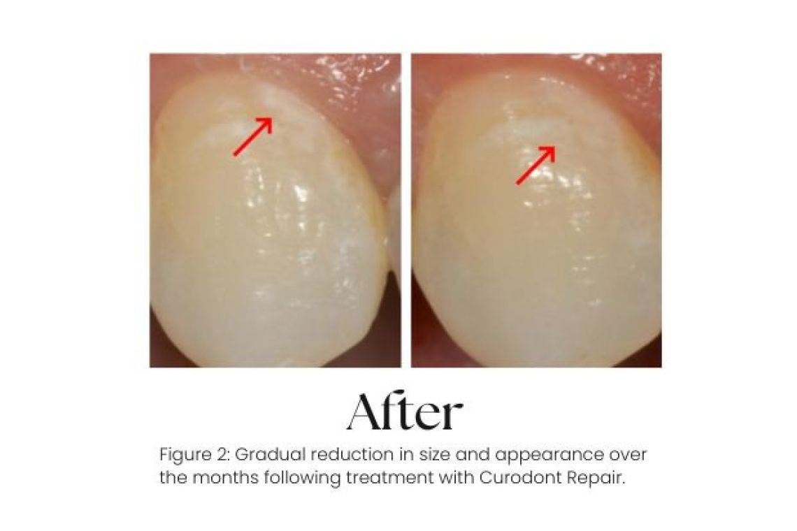 The same tooth after one application of Curodont Repair, with the white spot lesion noticeably reduced as the enamel has remineralised